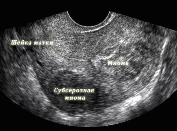 Полость матки деформирована. Узиекроз миоматозного узла. Субсерозная миома матки УЗИ. УЗИ органов малого таза миома матки.