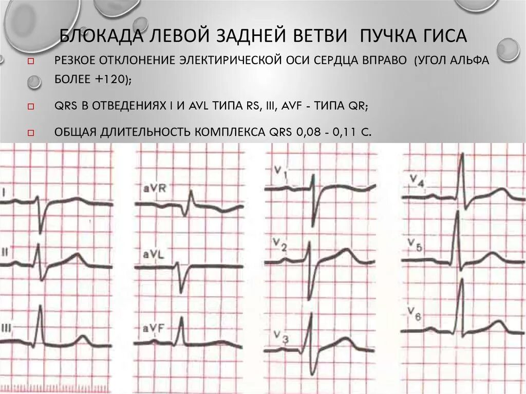 Блокада qrs. Блокада задней ветви ЛНПГ. Блокада задне нижней ветви левой ножки пучка Гиса. Блокада задней ветви левой ножки пучка. Блокада левой ножки пучка Гиса на ЭКГ.