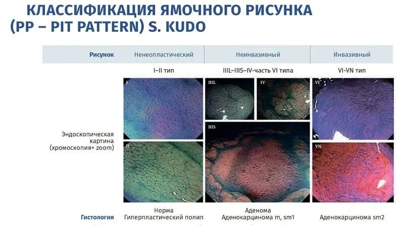 Kudo классификация эндоскопическая. Классификация рельефа поверхности Pit pattern Kudo-Fujii 2010. Классификация КУДО полипов толстой кишки. Эндоскопическая классификация полипов. Классификации эндоскопия