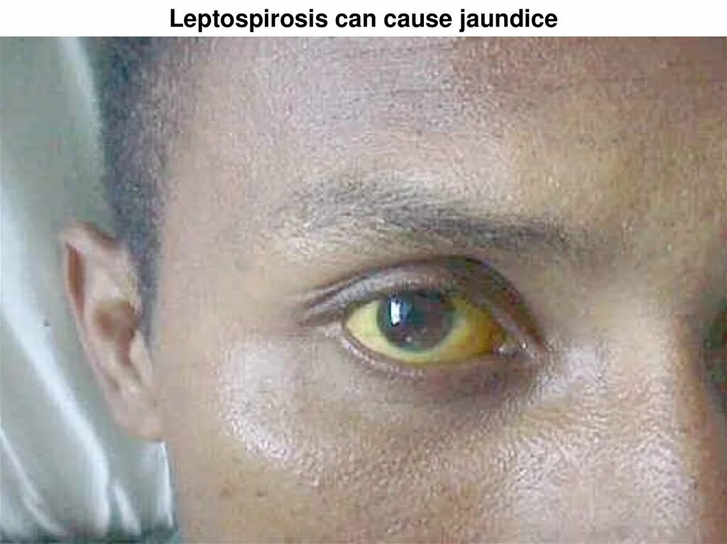 Иктерогеморрагический лептоспироз. Лептоспироз желтушная и безжелтушная форма. Безжелтушный лептоспироз. Лептоспироз гепатит