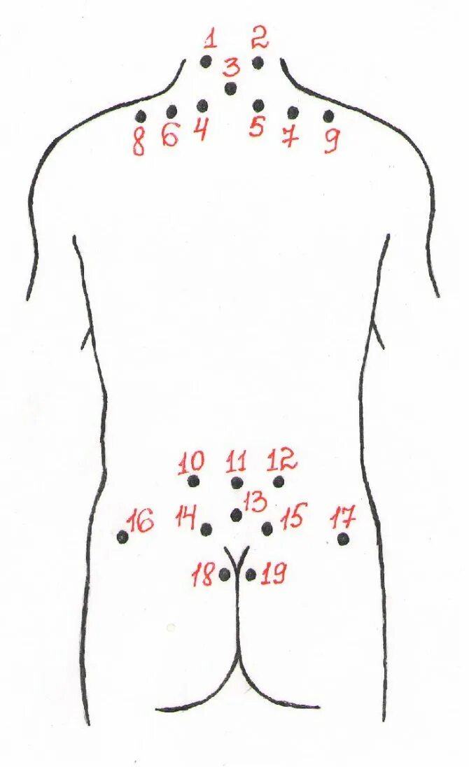Банки при болях в спине. Схема точек постановки пиявок. Схема постановки пиявок при шейном остеохондрозе. Гирудотерапия схема постановки пиявок на крестец. Гирудотерапия схема постановки пиявок остеохондроз.