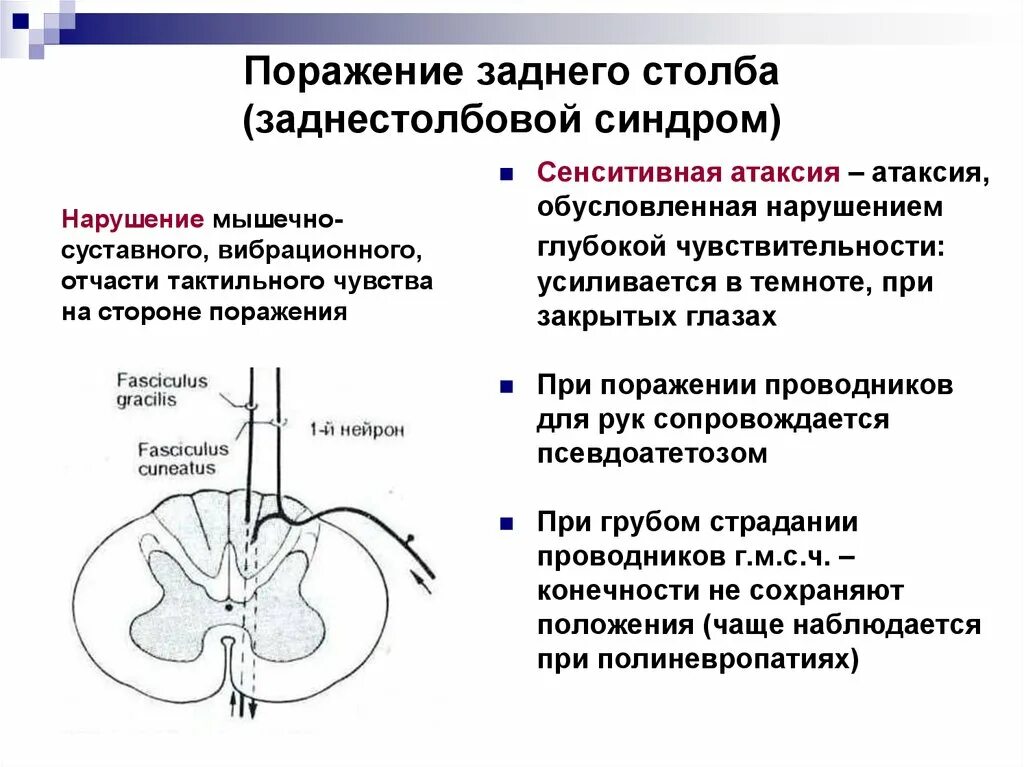 Локализация поражения при сенситивной атаксии. Поражение задних столбов спинного мозга нарушение чувствительности. Синдром поражения задних канатиков. Синдром сенситивной атаксии неврология.