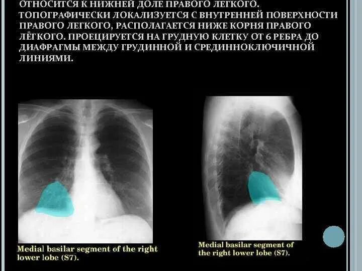 Доли правого легкого. Образование нижней доли правого легкого. Ателектаз нижней доли правого легкого.