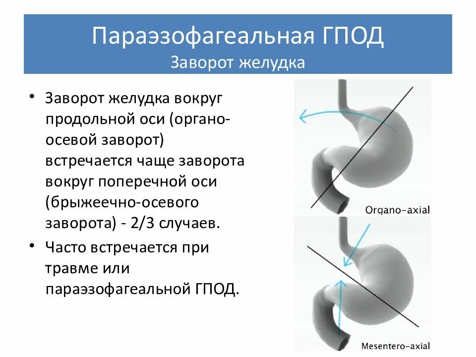 Параэзофагеальная грыжа диафрагмы. Параэзофагеальная грыжа патогенез. Параэзофагеальные грыжи диафрагмы клиника. Параэзофагеальная грыжа рентген. Грыжа пищеводного отверстия причины