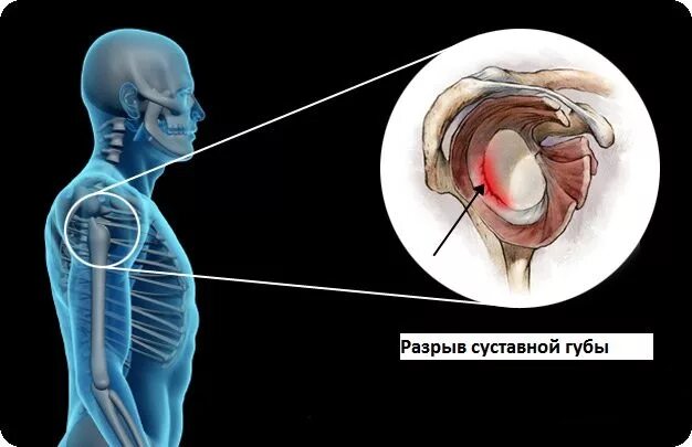 Плечевая губа суставная разрыв. Фиброзно-хрящевая губа гленоида. Верхний сегмент суставной губы плечевого сустава. Повреждение суставной губы гленоида. Фиброзно хрящевая губа гленоида лопатки.