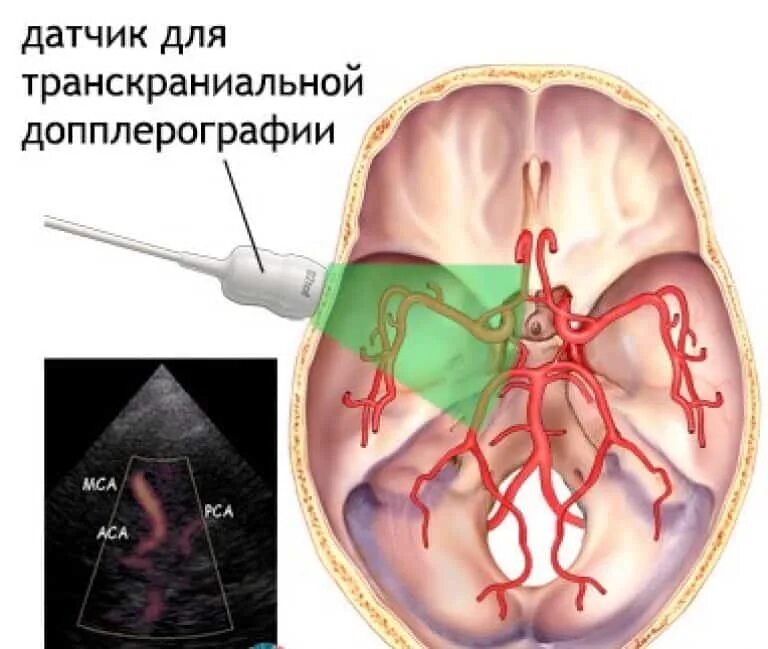 Узи головного мозга как подготовиться. Транскраниальная ультразвуковая допплерография. Транскраниальный датчик УЗИ. Допплеровское сканирование сосудов шеи. Транскраниальная допплерография сосудов головного.