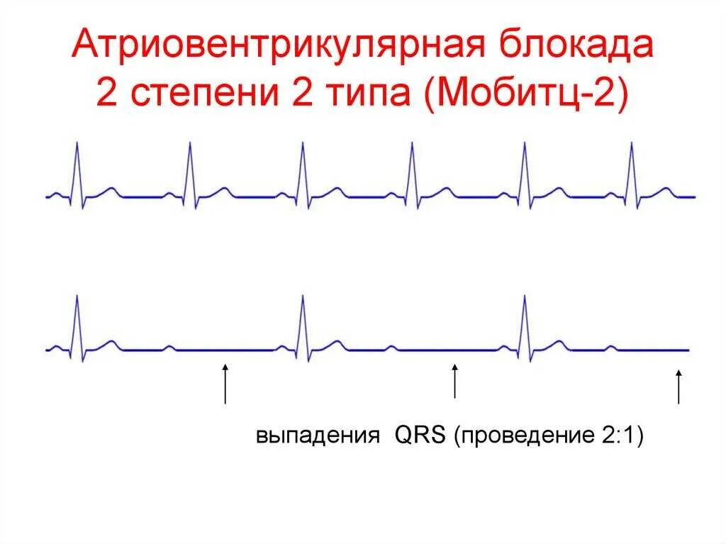 Атриовентрикулярная блокада 2. АВ блокада Мобитц 2 на ЭКГ. АВ блокада 2 степени Мобитц 2 на ЭКГ. АВ блокада II степени Тип Мобитц II. Атриовентрикулярная блокада 2 степени 2 типа (Мобитц-2).