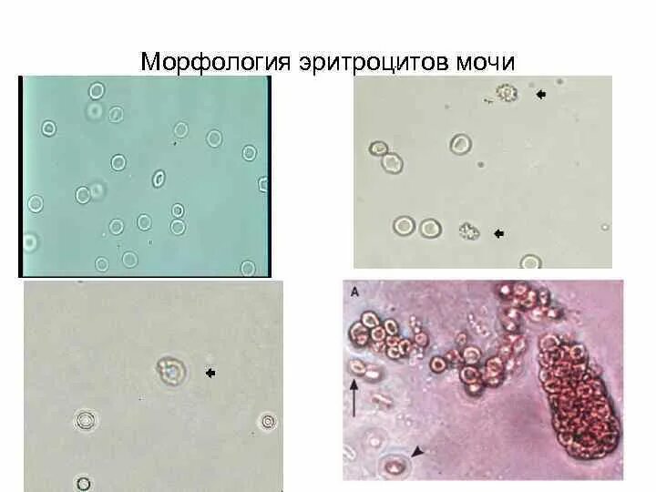 Измененные эритроциты в моче микроскопия. Эритроциты в моче микроскопия. Выщелоченные эритроциты в моче под микроскопом. Морфология эритроцитов в моче измененные. Появление эритроцитов в моче