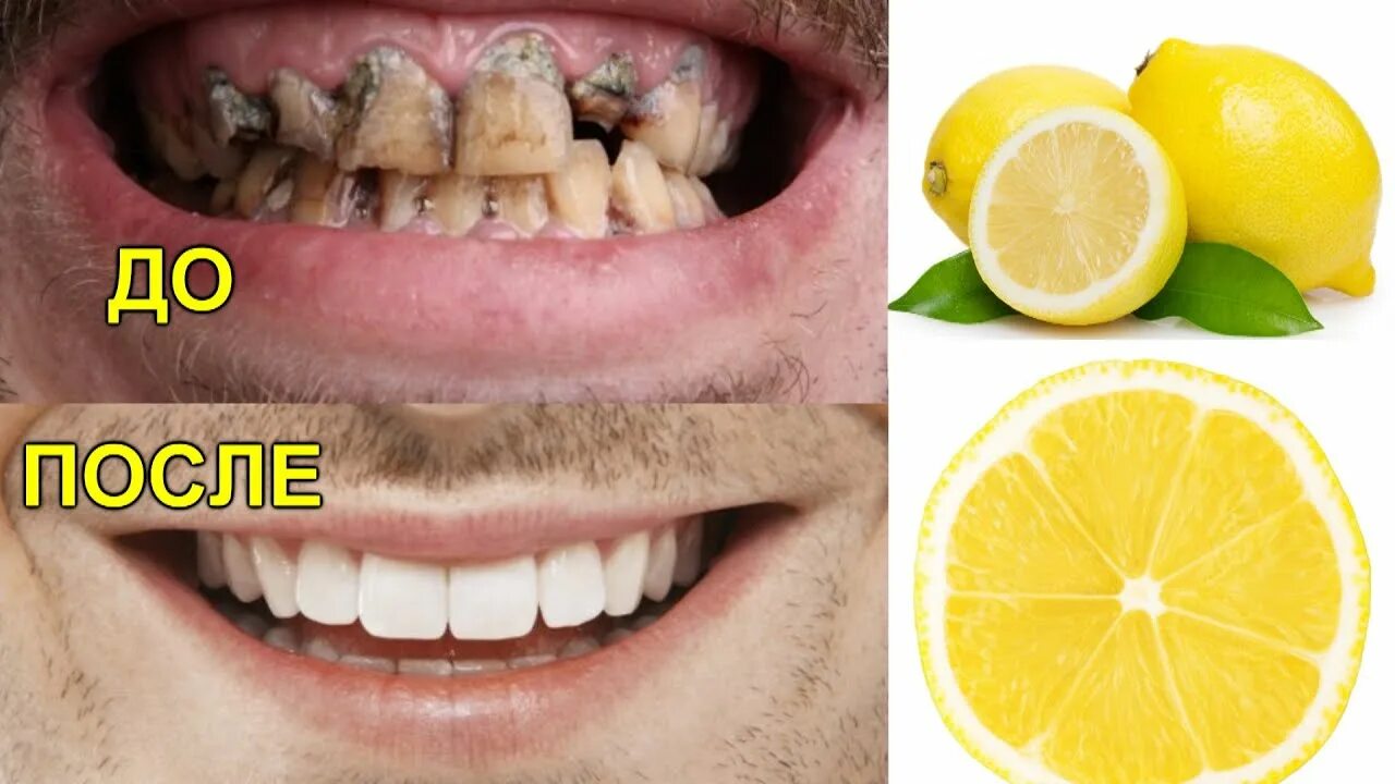 Зубы желтый чистить. Отбеливание зубов. Лимон в зубах.