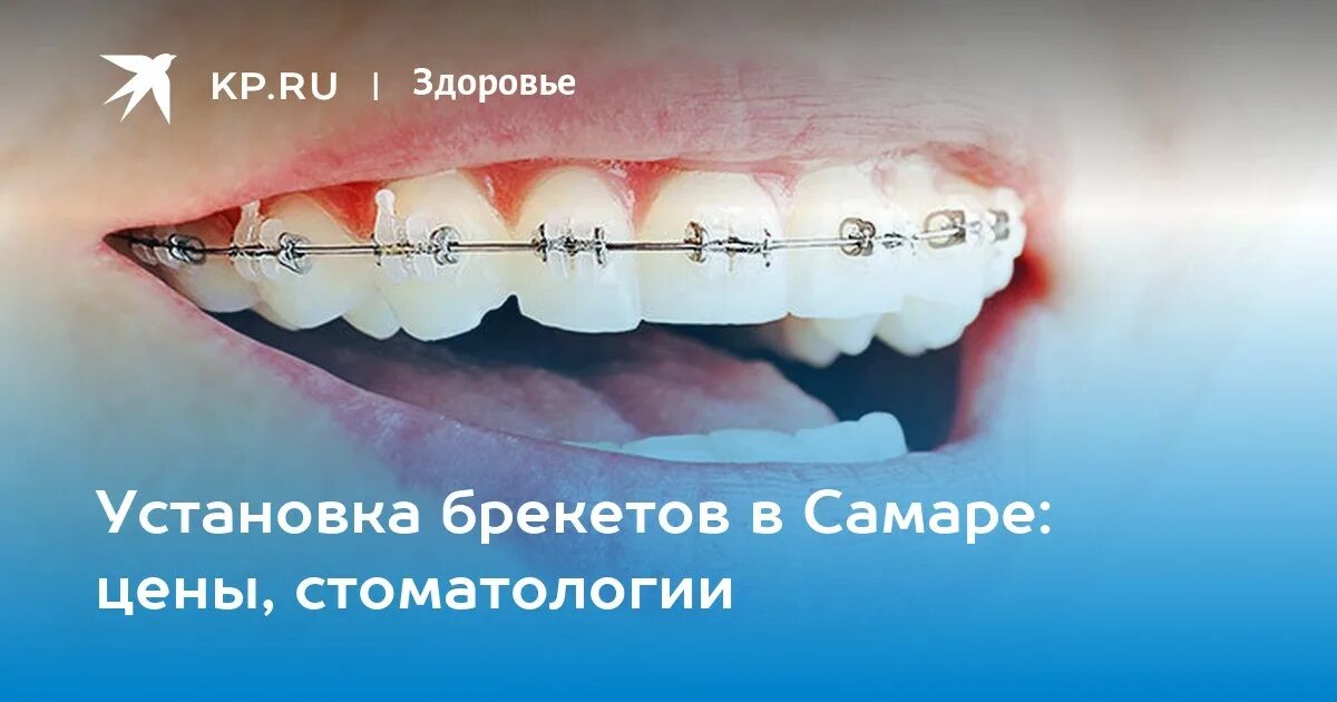 Сколько стоят брекеты в самаре. Установка брекетов самара. стоимость брекетов в самаре.