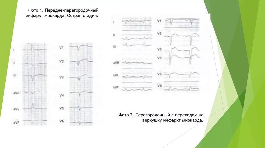 Изменение миокарда передне перегородочной области. Острый передне-перегородочный инфаркт миокарда. Передне перегородочно верхушечный инфаркт. ЭКГ передне перегородочный инфаркт. Инфаркт миокарда передне перегородочный верхушечный.