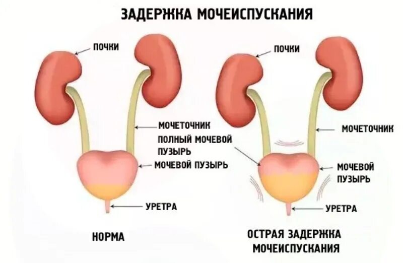 Рези в мочеиспускательном канале. Задержка мочеиспускания. Задержка мочеиспускания - ишурия. Переполненный мочевой пузырь.