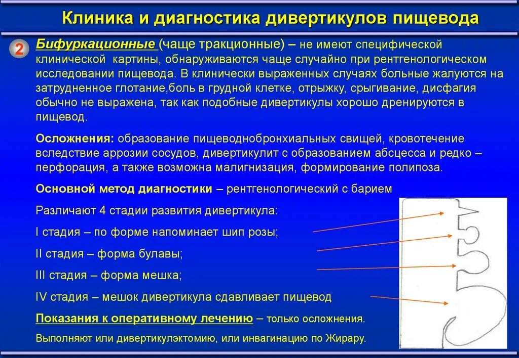 Какая болезнь пищевода. Дивертикулы пищевода классификация. Дивертикулы пищевода клиника. Заболевания пищевода хирургия. Бифуркационный дивертикул пищевода.