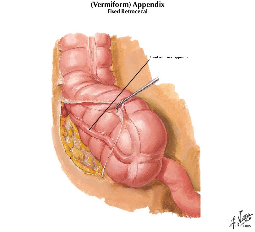 Аппендикс червеобразный. Ретроцекальный аппендикс. Червеобразный отросток при аппендиците. Аппендицит забрюшинное расположение. Купол слепой кишки и аппендикса.