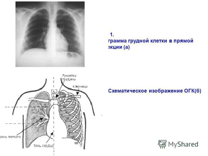 Рентген огк боковая проекция. Рентген огк. Рентгенограмма огк в прямой проекции. Правосторонняя пневмония рентген. Рентген грудной клетки в боковой проекции норма.