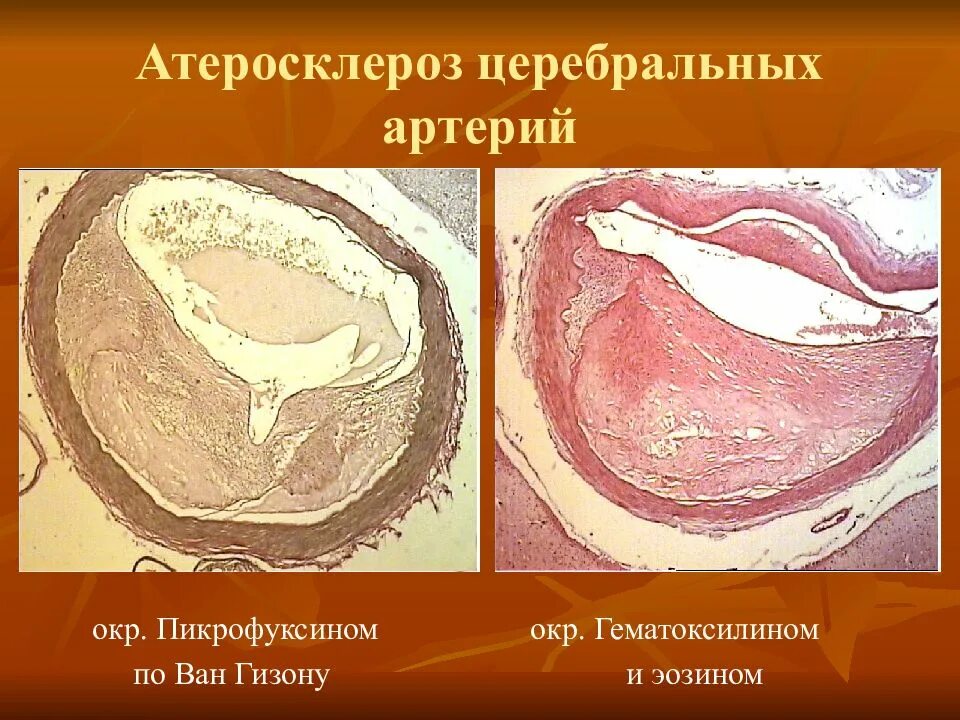 Атеросклероз церебральных сосудов симптомы. Атеросклероз церебральных артерий. Атеросклероз церебральных сосудов жалобы. Атеросклероз церебральных артерий микропрепарат. Атероматозная бляшка в аорте микропрепарат.