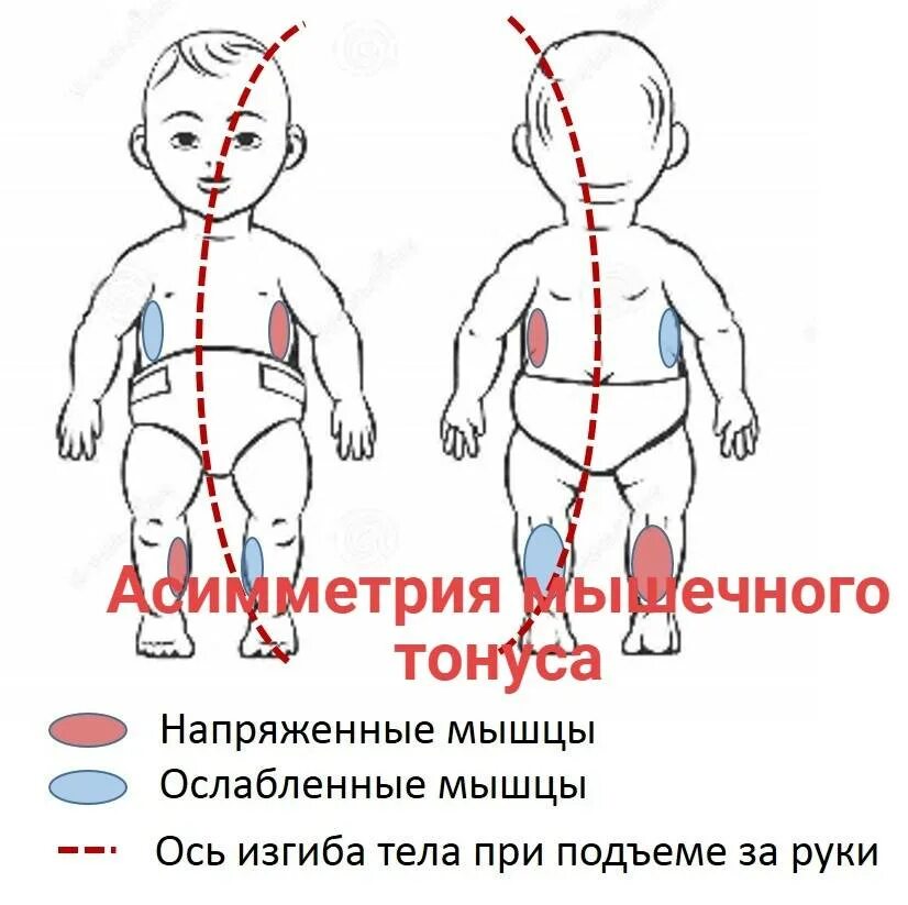 Как отличить тонус. Асимметрия туловища у грудничка. Мышечный гипертонус у новорожденного. Гипертонус мышц у новорожденных. Гипертонус мышц новорожденного.