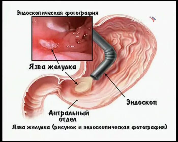 Язва курлинга. Язва двенадцатиперстной кишки фгдс. язвенная болезнь желудка эндоскопически. язва желудка гастроскопия.