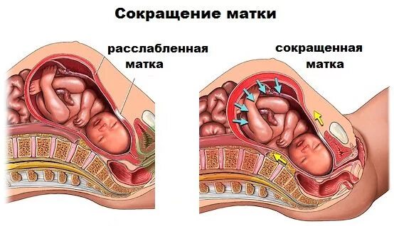 Гипертонус Матки Можно Заниматься Сексом