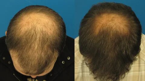 propecia hair loss side effects.