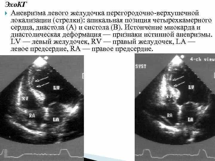 Тромб в желудочке. Аневризма верхушки лж ЭХОКГ. Постинфарктный аневризма ЭХОКГ. Аневризма задней стенки левого желудочка по ЭХОКГ. Аневризма левого желудочка на УЗИ.