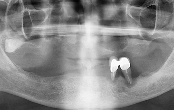 Скрытая патология. Снимок ОПТГ беззубой челюсти. Полная адентия рентген.
