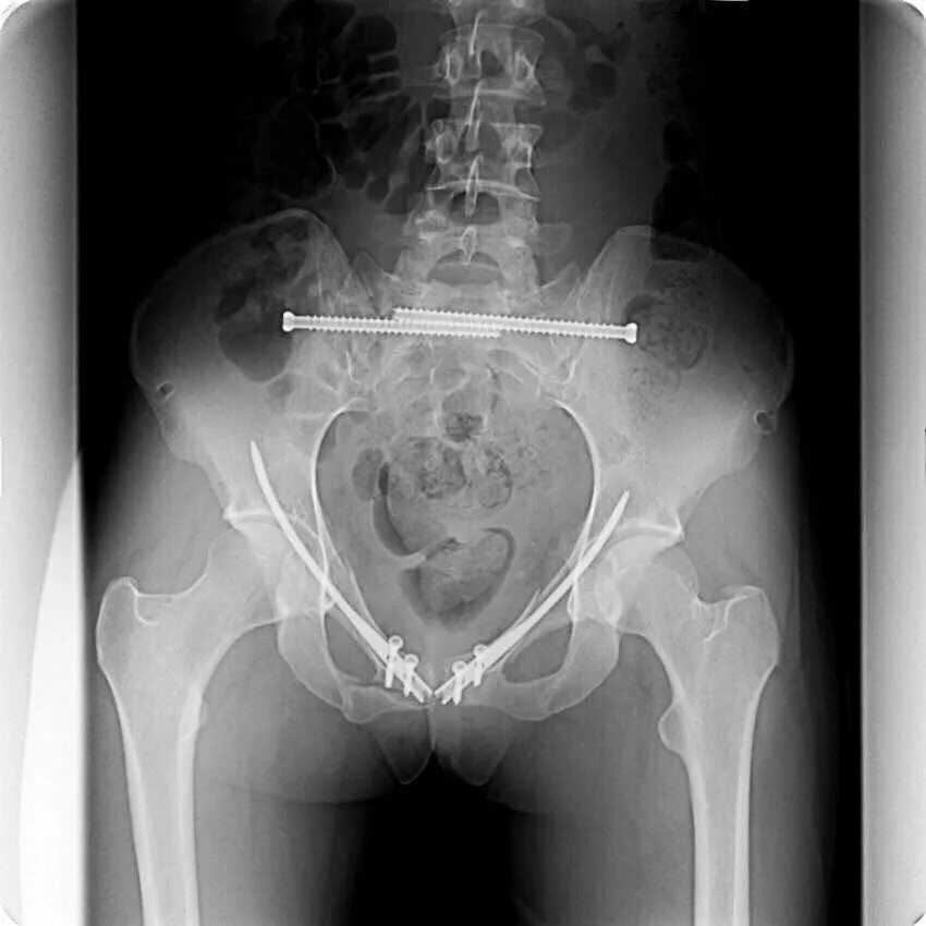 Чрескостный остеосинтез КПС илеосакральными винтами рентген. Оскольчатый перелом седалищной кости. Перелом лонного сочленения рентген.