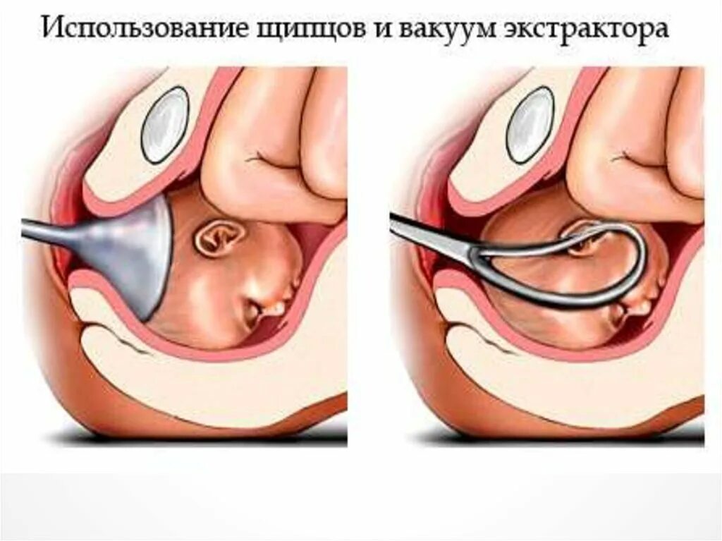 Сколько длится вакуумный. Вакуум-экстракция плода в родах. Вакуум экстрактор акушерский. Искусственное прерывание родов. Роды с акушерскими щипцами.