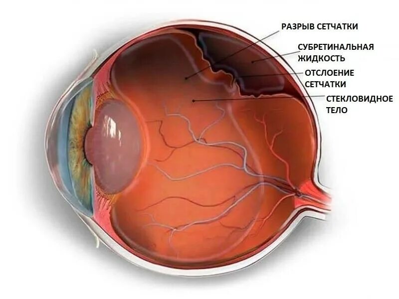 Изображение на сетчатке глаза появляется. Гиалоидная мембрана стекловидного тела. Отслойка мембраны стекловидного тела. Отслойка сетчатки глазное дно. Тракционная отслойка сетчатки глаза.