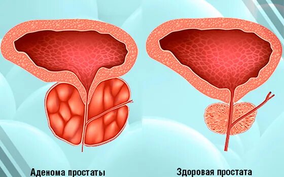 Чем грозит простата. Аденома доброкачественная гиперплазия. Аденома предстательная железа у мужчин. Доброкачественная опухоль предстательной железы.