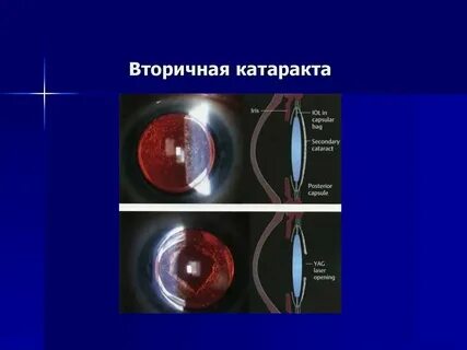 Симптомы вторичной катаракты после замены