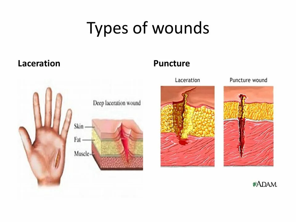 Как переводится wound