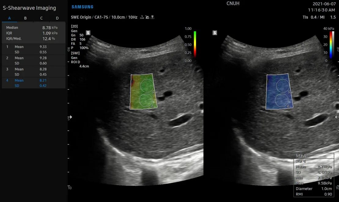 Эластография сдвиговой волны печени. УЗИ эластография печени. Эластометрия сдвиговой волной. Протокол эластография сдвиговой волны.