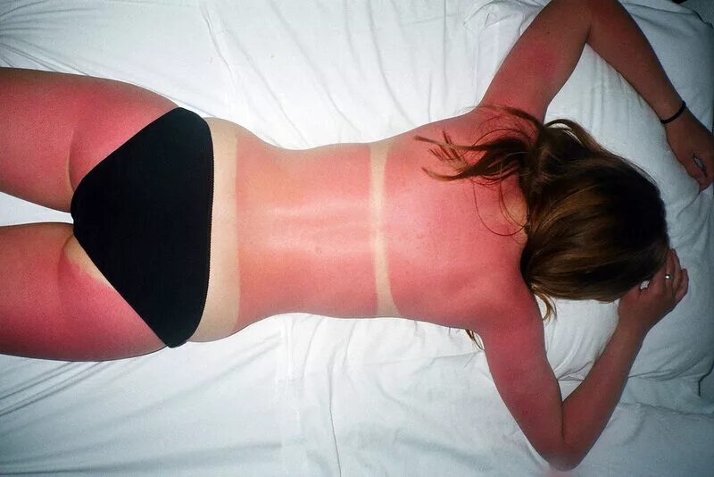 сгорела в солярии. сгорела в солярии. лицо перегорело после солярия. сгорела в солярии. сильно обгорел на солнце.