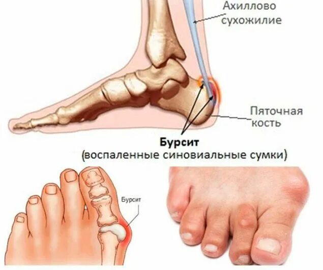 Болит ступня большой палец. Воспаление сухожилия кости стопы. Бурсит большого пальца сбоку. Пяточный бурсит симптомы.