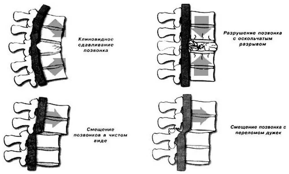 Повреждения позвоночника переломы. Классификация позвоночно-спинномозговой травмы. Виды переломов спинного мозга. Компрессионный перелом позвонка типы. Осложненные переломы позвонков классификация.