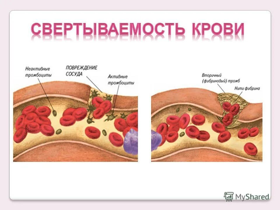 тромбоциты свертывание крови. механизм адгезии тромбоцитов. покрышка атеросклеротической бляшки. холестериновые бляшки в коронарных артериях. тромб при повреждении сосуда.