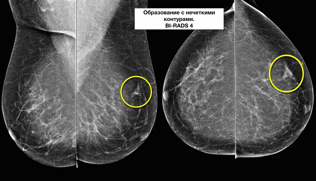 Категория bi rads 2 молочных желез. Bi-rads 3 молочной железы маммограмма. Маммография молочных bi-rads 2. Маммография молочных желез bi rads 4. Bi rads маммография.