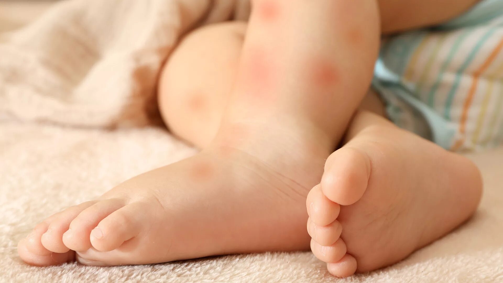Детский кожный. Аллергические пятна на ногах у ребенка. Аллергическая сыпь на ногах у ребенка.