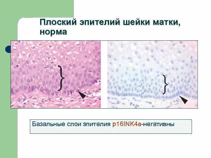 Эпителий какая норма. Эпителий шейки матки гистология. Многослойный плоский эпителий шейки. Эпителий шейки матки гистология строение. Многослойный плоский эпителий шейки матки.