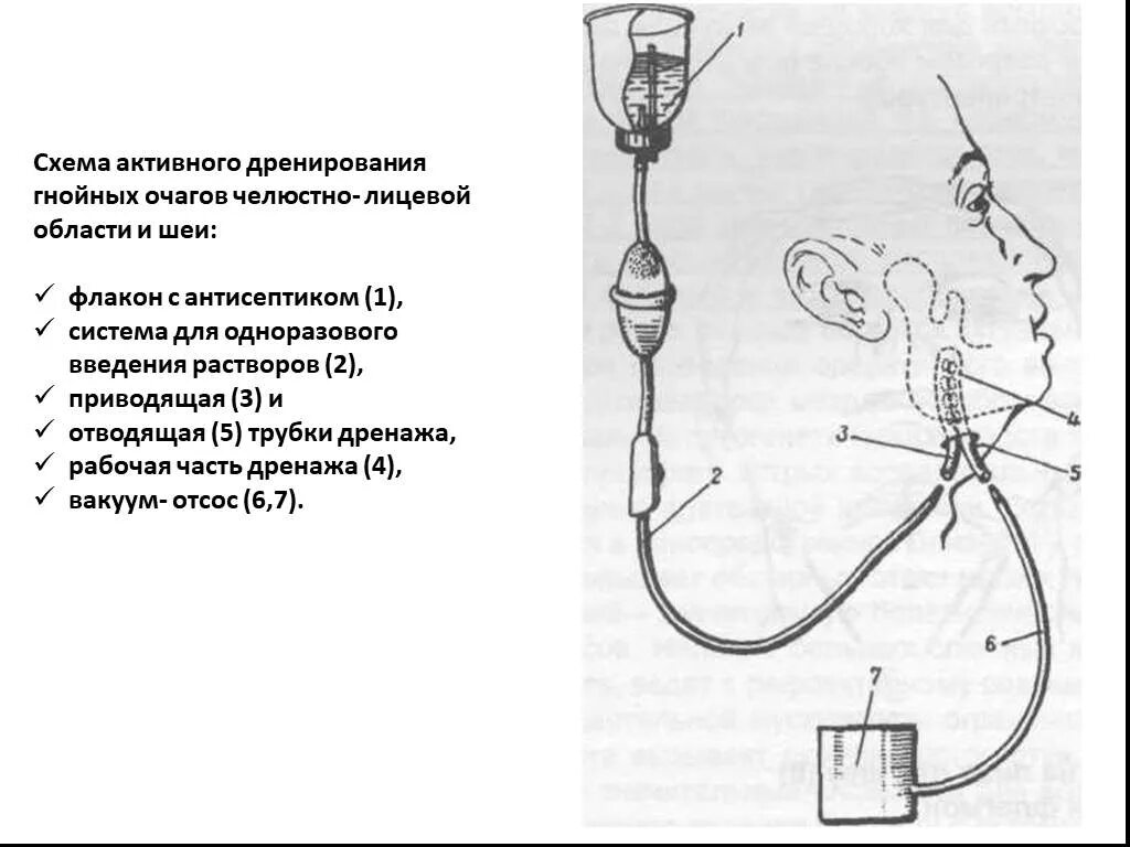 Дренирование гнойны ран. Дренирование флегмоны ЧЛО. Активный дренаж хирургия схема. Активное дренирование схема. Схема проточно-промывной системы для диализа раны.