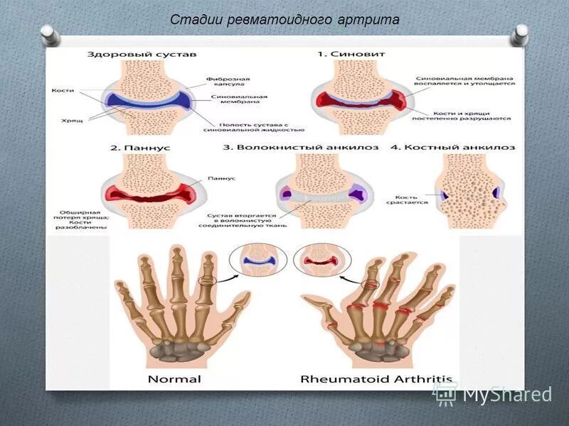 Ранняя стадия ревматоидного артрита