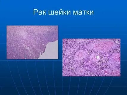 Карцинома g2 шейки матки