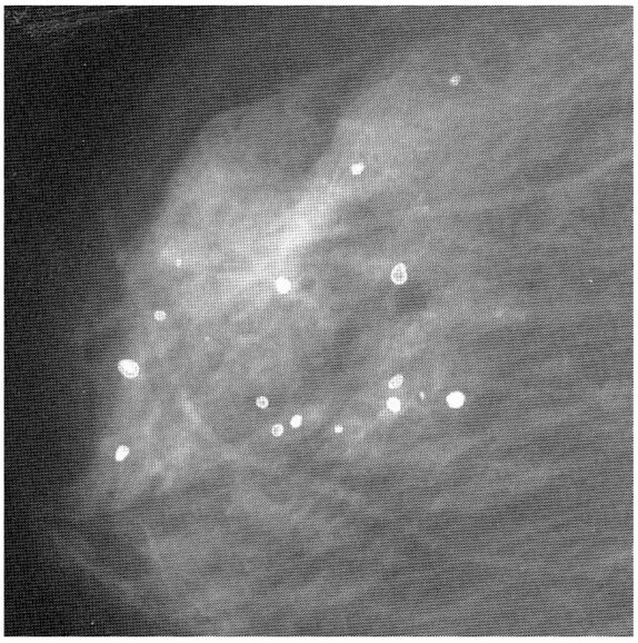 Галактоцеле на маммографии. Рентгенодиагностика галактоцеле. Белые пятна на молочных железах. Галактоцеле молочной железы на маммограмме. Нажать на сосок