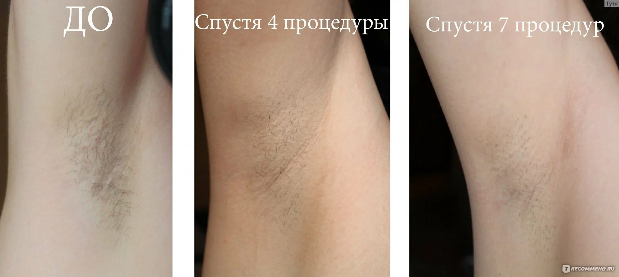 Фотоэпилятор SMOOTHSKIN. Лазерная эпиляция. Лазерная эпиляция до и после. Лазерная эпиляция подмышки.