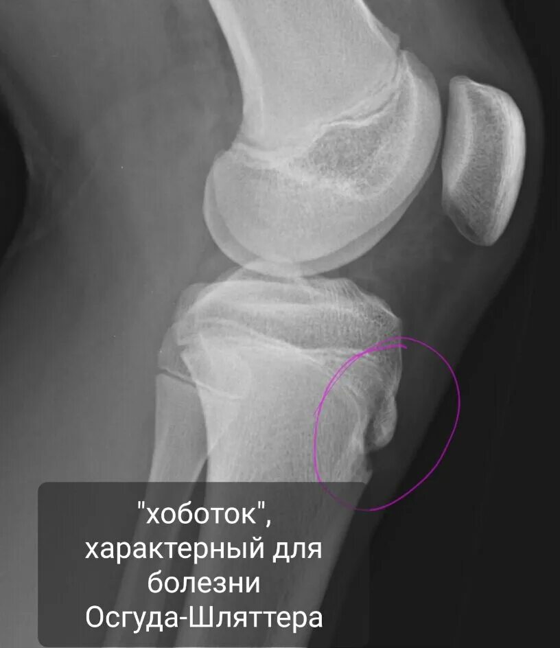 Шляттера мкб 10. Болезнь коленного сустава Осгуда-Шлаттера. Остеохондропатия Осгуда-Шлаттера. Болезнь Осгуда-Шлаттера рентген. Осгуд Шляттера болезнь рентген.