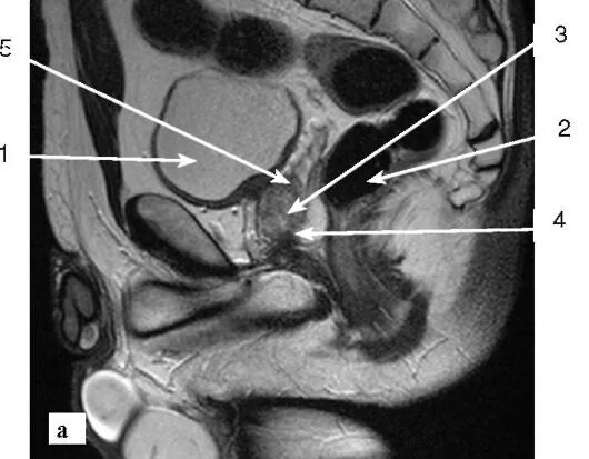 Кт малого таза с контрастом у мужчин. Предстательная железа мрт сагитал. Анатомия семенных пузырьков мрт. Мрт малого таза Сергея Березина. Мрт малого таза простата.