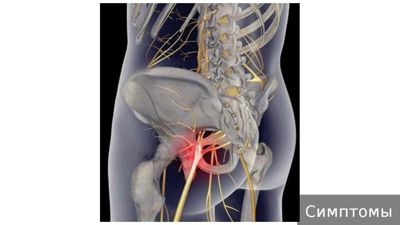 Сильно болит седалищный нерв. Ишиас седалищного нерва. Ишиас седалищного нерва симптомы. Ишиас - защемление седалищного нерва.