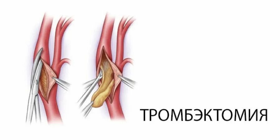 Артерия тромб удаление