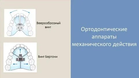 Ортодонтические аппараты механического действия